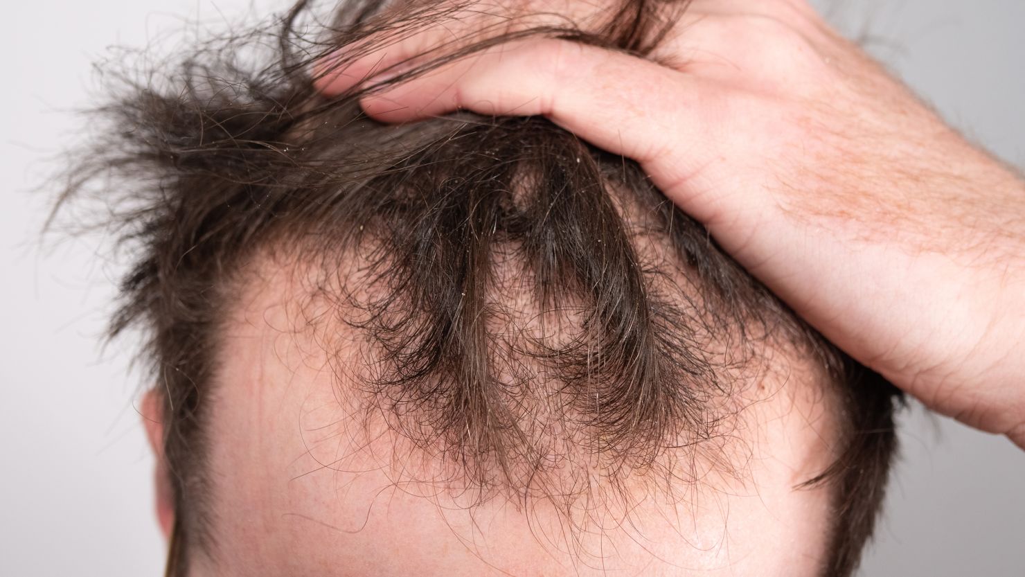 Diseases Leading to Hair Loss